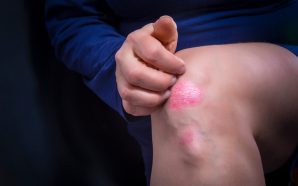 What is Plaque Psoriasis?