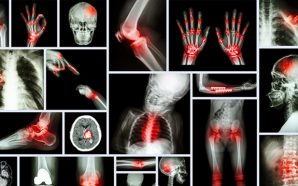 Arthritis: Critical Information