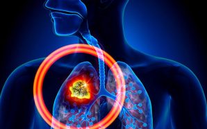 Symptoms, Causes and Treatments of Lung Cancer