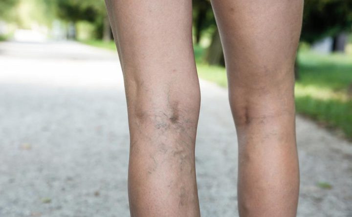 what causes deep vein thrombosis?