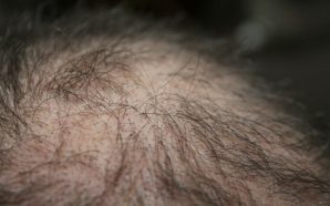 Get the Ultimate Hair Loss Treatment for Your Hair, hair loss, hair loss treatment