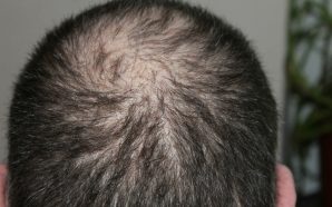 Get the Ultimate Hair Loss Treatment for Your Hair, hair loss