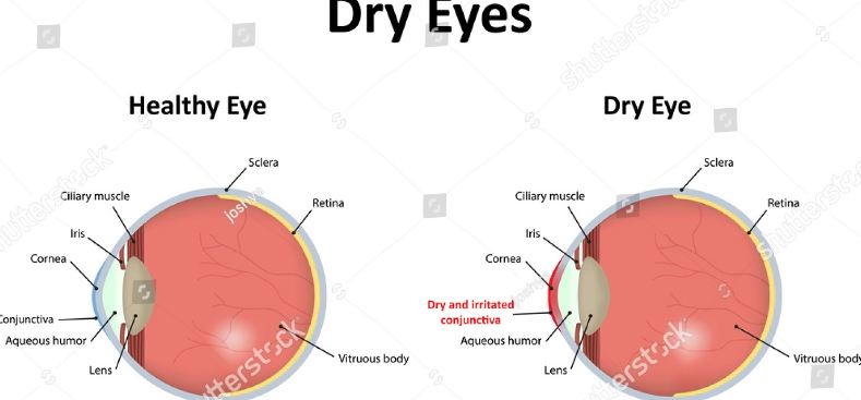 Dry eye syndrome causes