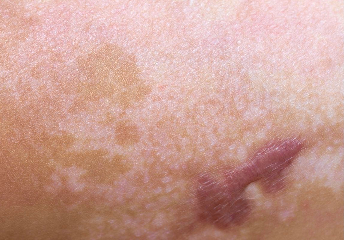 The Causes And Treatments Of Skin Rash